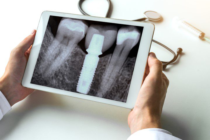 Dentist,Watching,A,Dental,X-ray,Teeth,With,Dental,Pivot,On