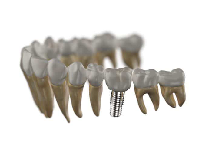 Molar,Teeth,Implant,With,Other,Lower,Teeth,Dental,Care,3d