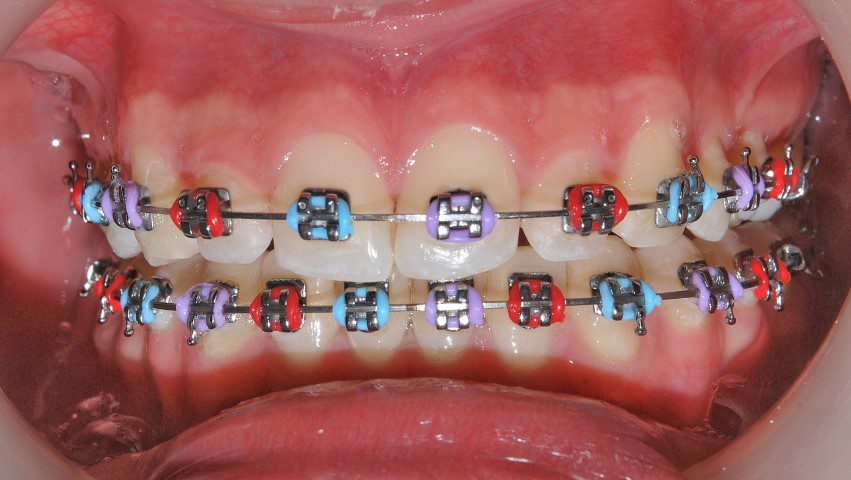 Ortodoncia Brackets (1)